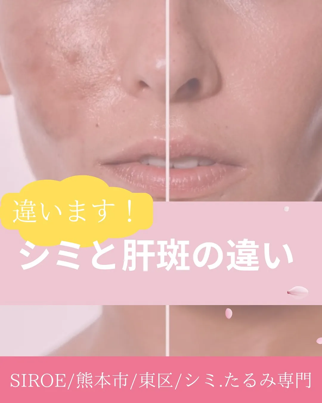 \老けて見える...年々濃くなるシミ/