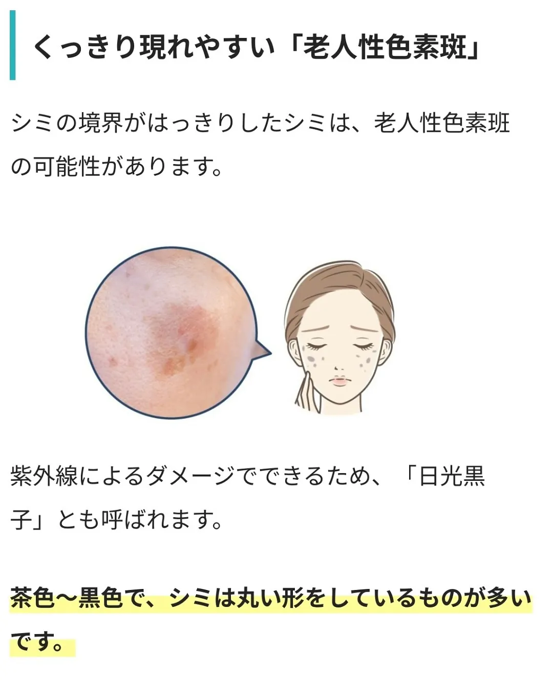 \老けて見える...年々濃くなるシミ/