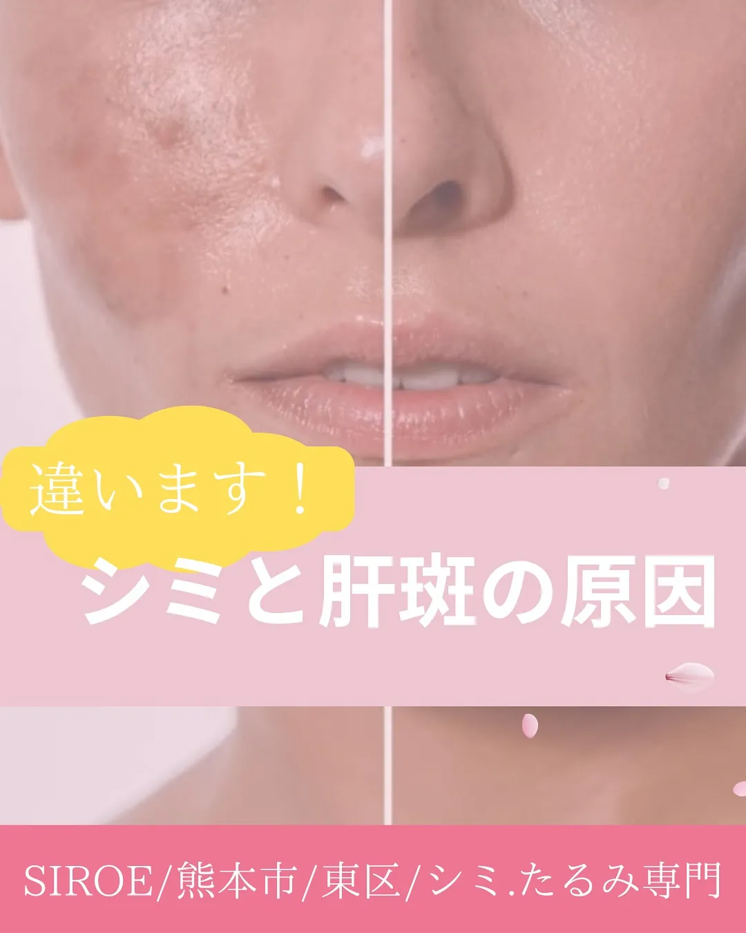 シミを薄くしたい✨