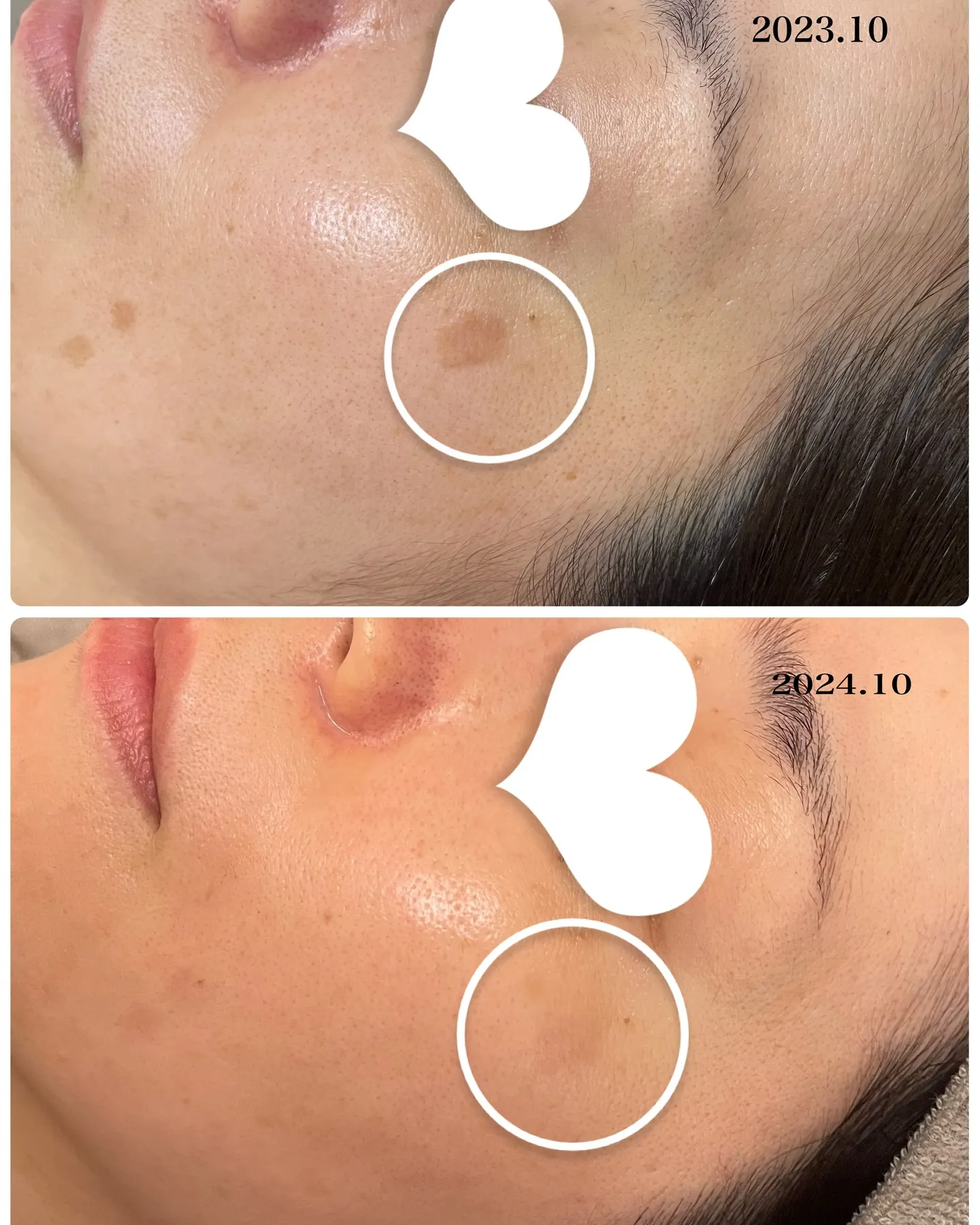 シミを薄くしたい✨