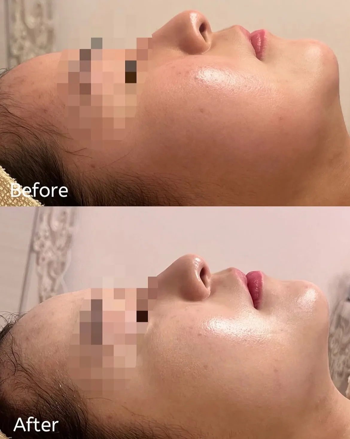 リフトアップマシンでフェイスラインをすっきり保つ効果的なケア法