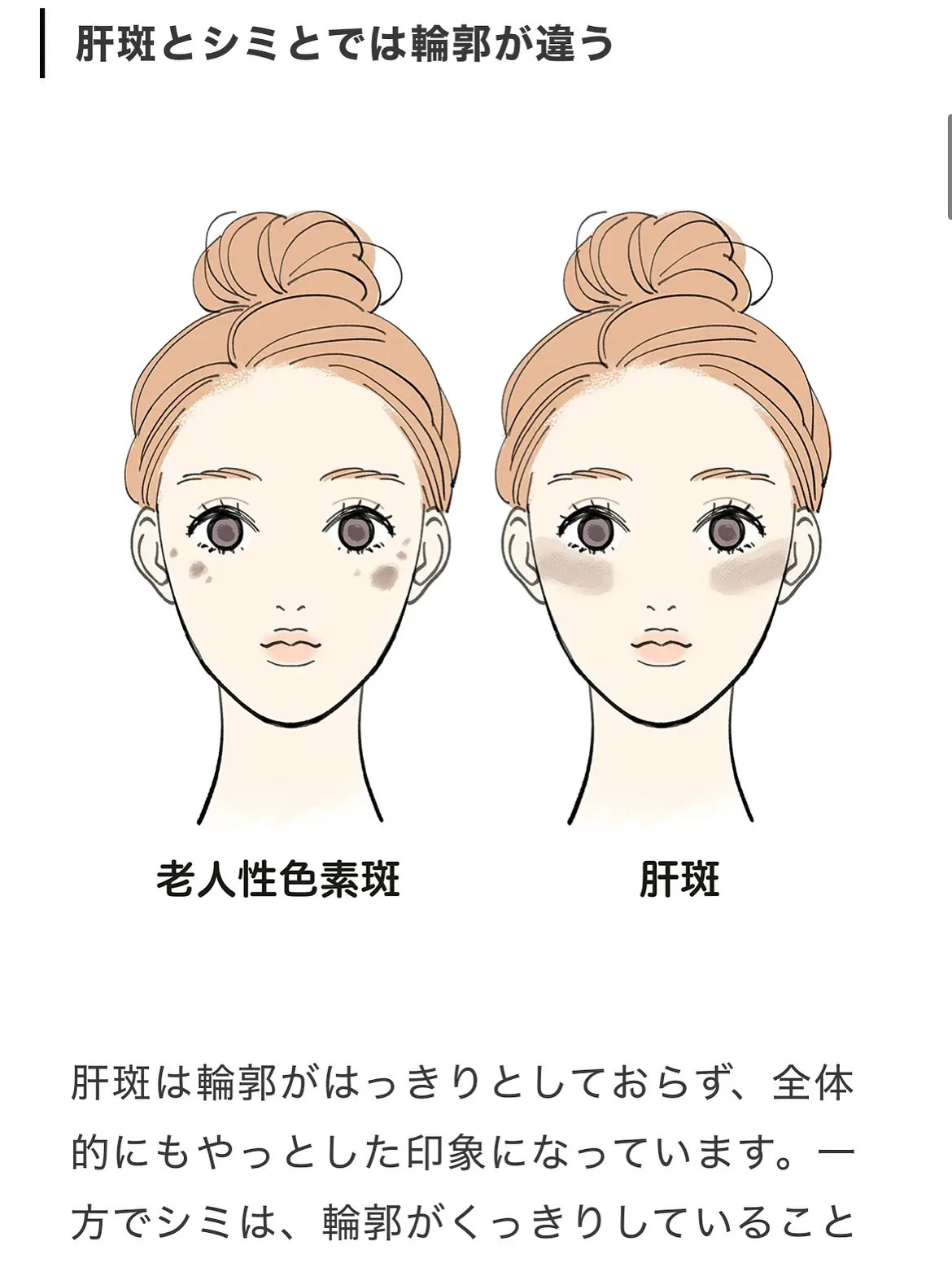 \普通のシミとはどう違う?/