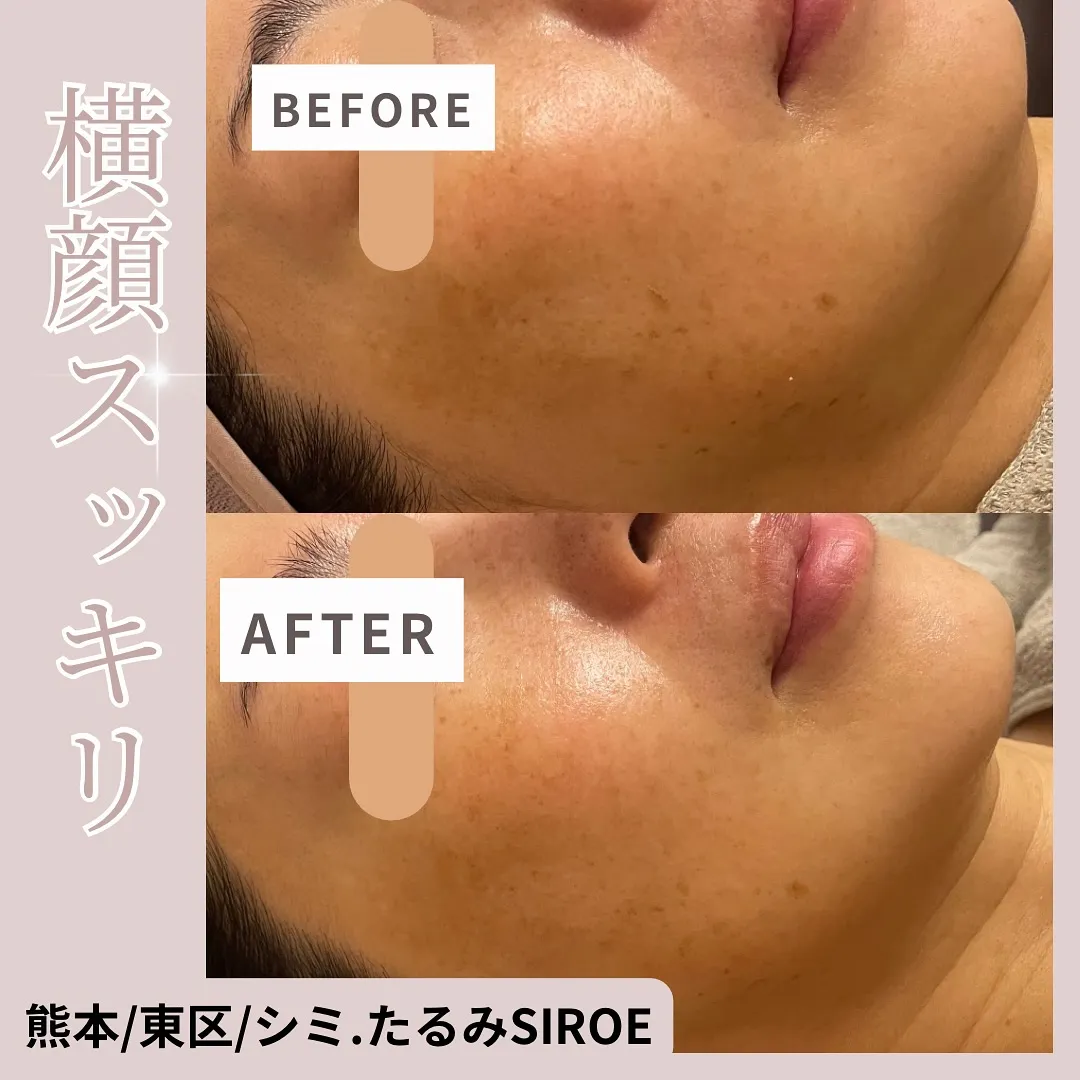 たるみ気になりだしたら‥