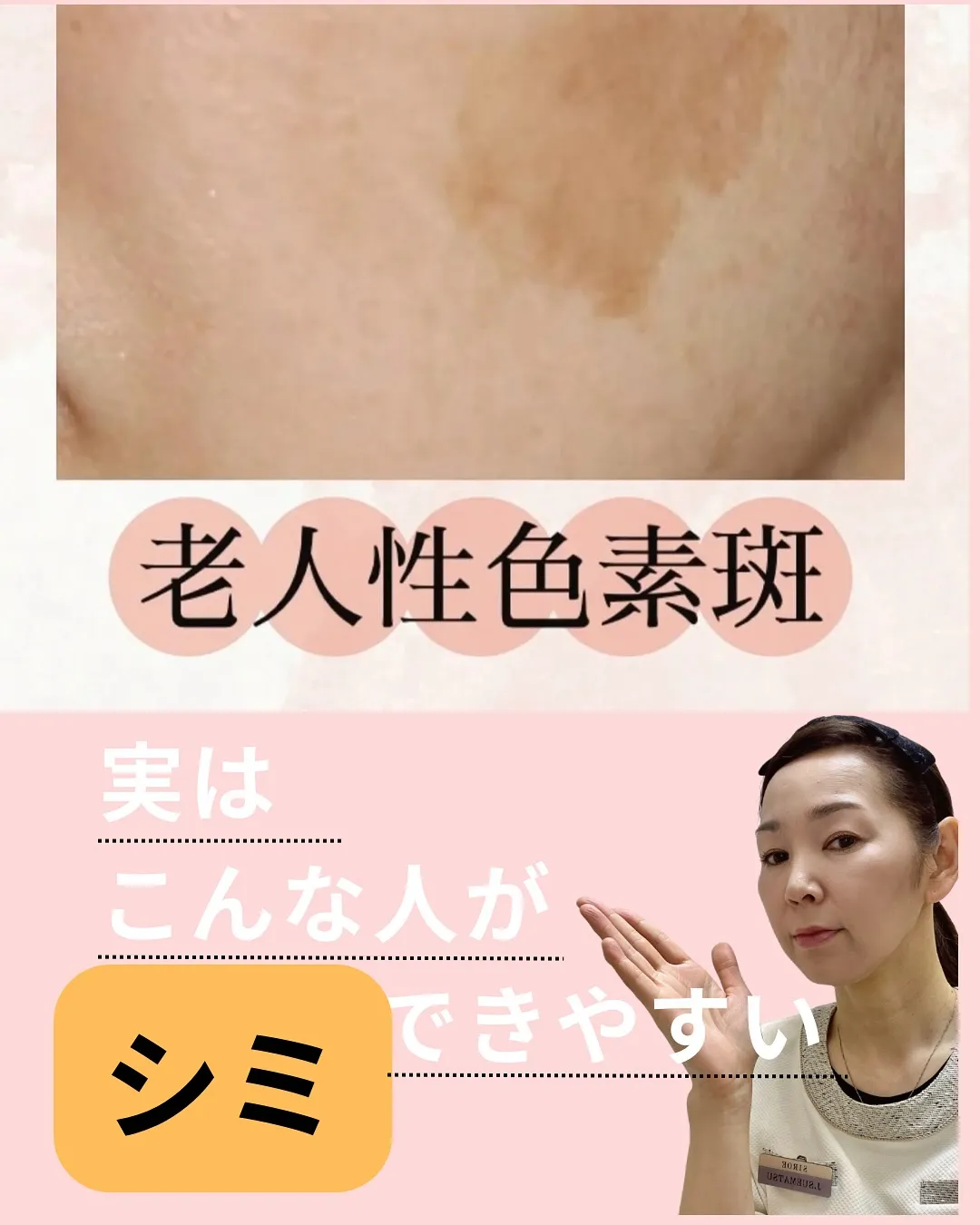 シミ濃くなった😭