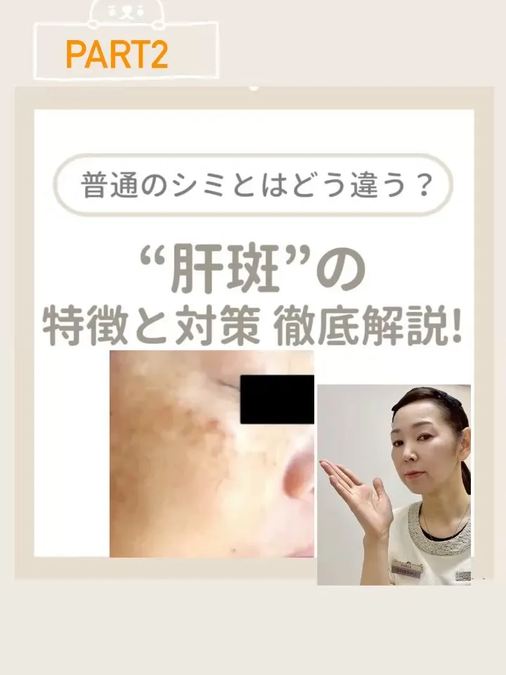 ＼普通のシミとはどう違う？/
